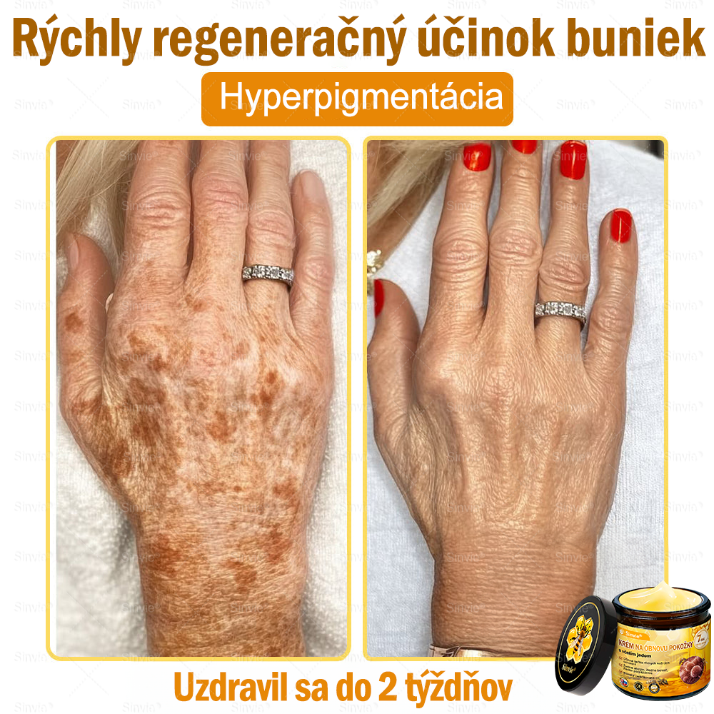 💛Sinvie® Krém na obnovu pokožky s včelím jedom 🔥 Odporúčané dermatológmi | Proti vráskam, pigmentovým škvrnám a ochabnutej pokožke – 50 ml