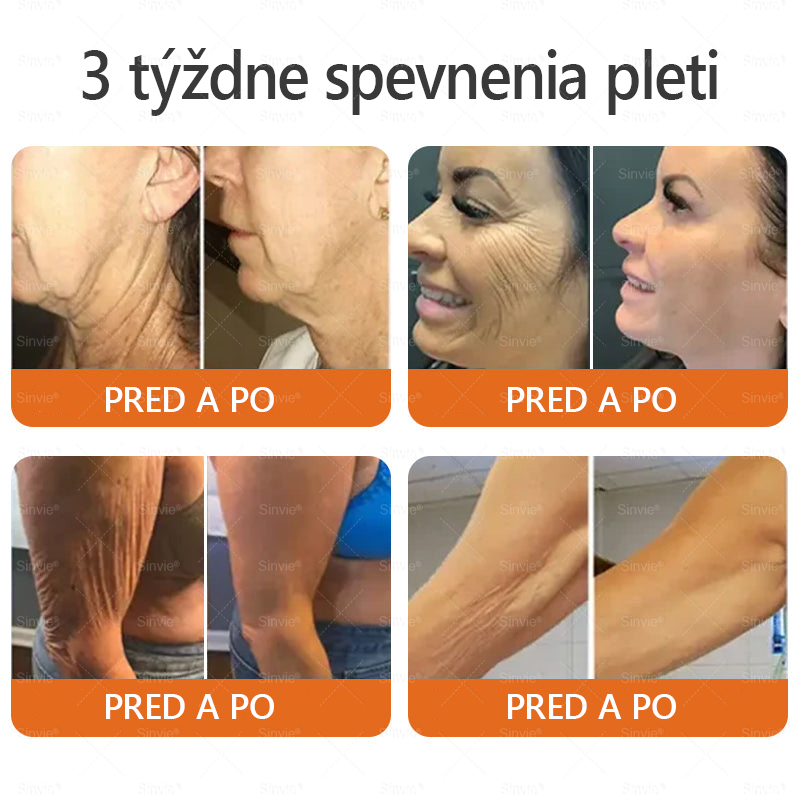 💛Sinvie® Krém na obnovu pokožky s včelím jedom 🔥 Odporúčané dermatológmi | Proti vráskam, pigmentovým škvrnám a ochabnutej pokožke – 50 ml