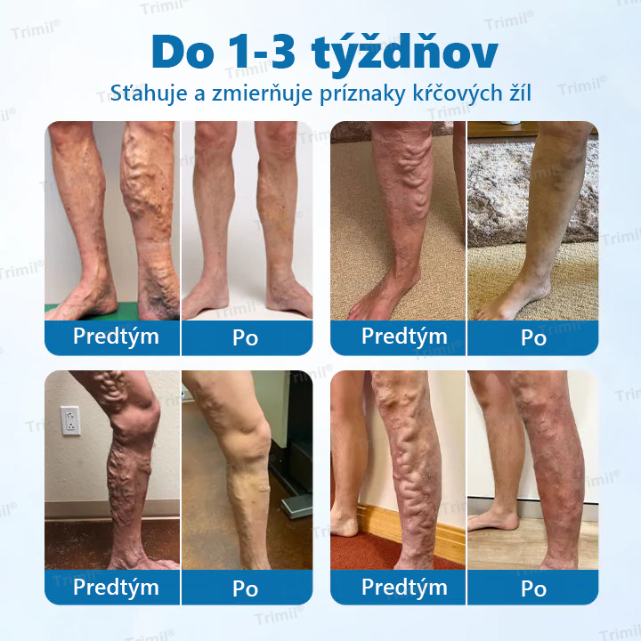 💙💙Trimil® Bylinný Sprej na Ochranu Žíl - ✅ Klinicky preukázané: Kŕčové žily zmiznú už za 7 dní!