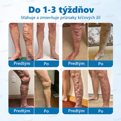 💙💙Trimil® Bylinný Sprej na Ochranu Žíl - ✅ Klinicky preukázané: Kŕčové žily zmiznú už za 7 dní!