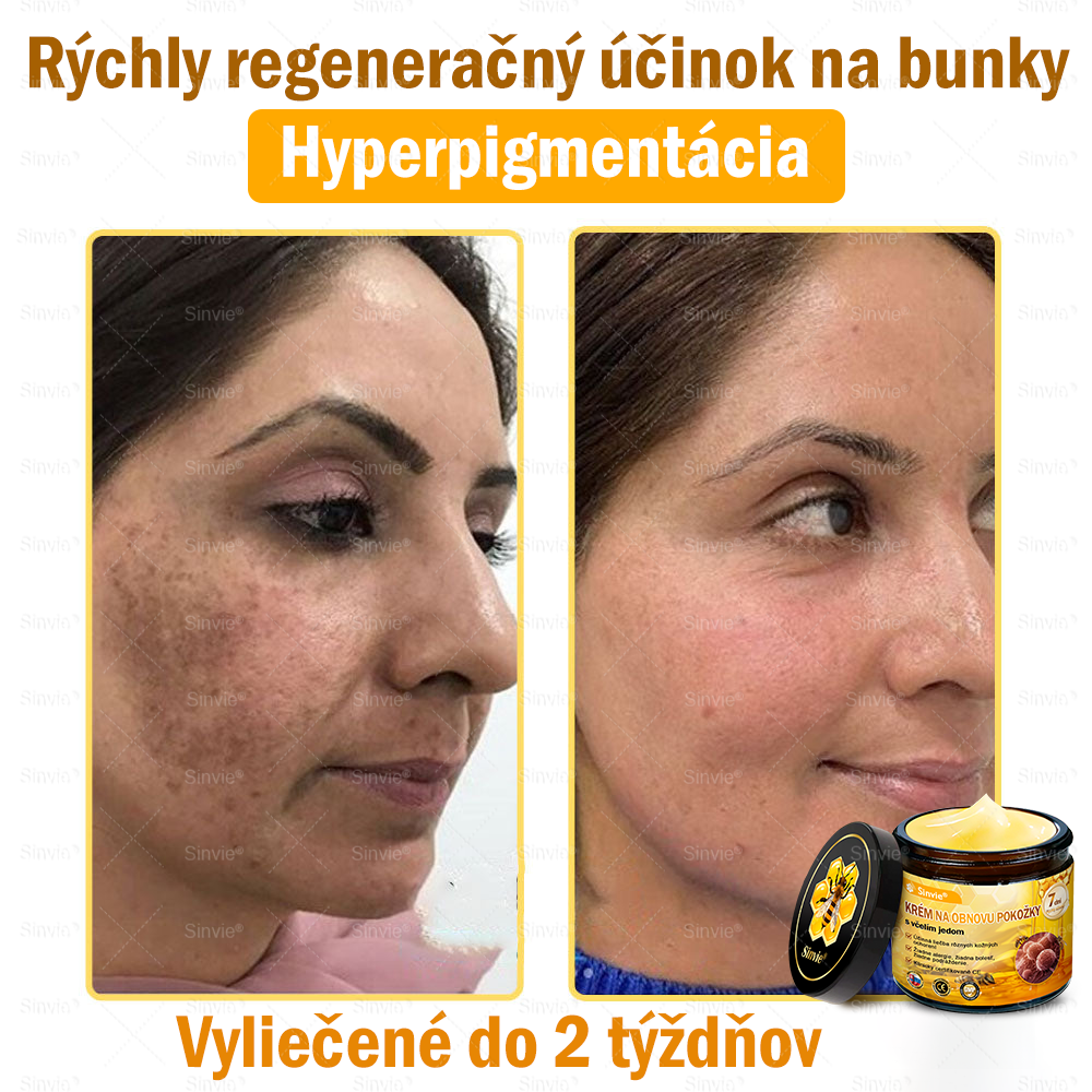 💛Sinvie® Krém na obnovu pokožky s včelím jedom 🔥 Odporúčané dermatológmi | Proti vráskam, pigmentovým škvrnám a ochabnutej pokožke – 50 ml