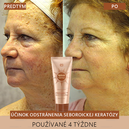 💟FRISSARC™ bieliaca a škvrny odstraňujúca pleťová maska –🍀Prírodné zložky trvalo odstraňujú pigmentové škvrny, starecké škvrny, pehy a slnečné škvrny.