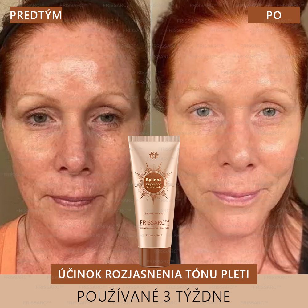 💟FRISSARC™ bieliaca a škvrny odstraňujúca pleťová maska –🍀Prírodné zložky trvalo odstraňujú pigmentové škvrny, starecké škvrny, pehy a slnečné škvrny.